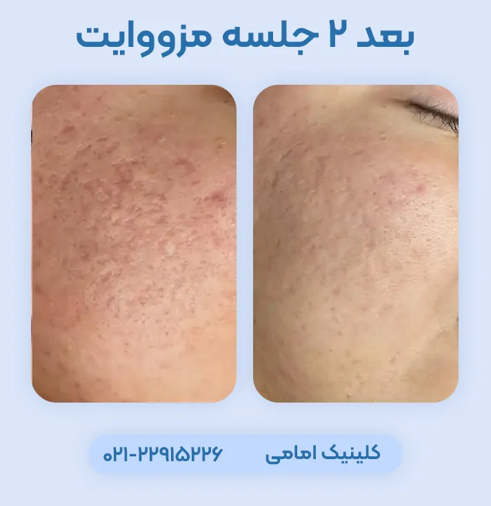 قبل بعد مزووایت