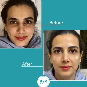 قبل و بعد تزریق مزوژل