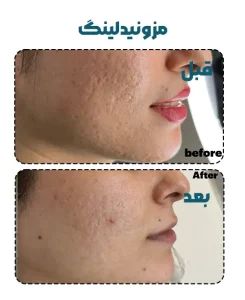 مزونیدلینگ