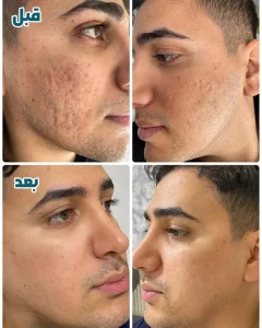 مزونیدلینگ