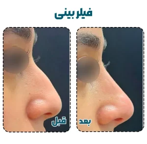 فرم دهی بینی با فیلر