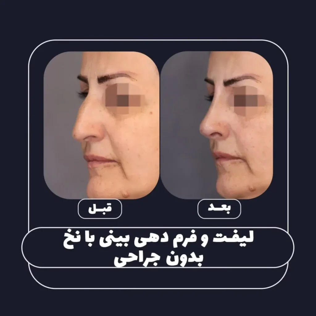 فرم دهی بینی بدون جراحی