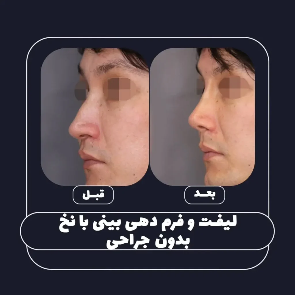 فرم دهی بینی بدون جراحی
