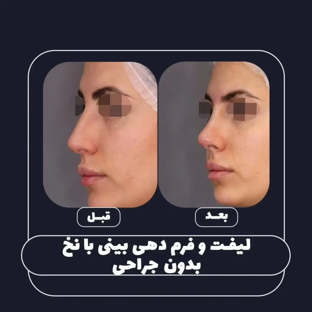 فرم دهی بینی با نخ