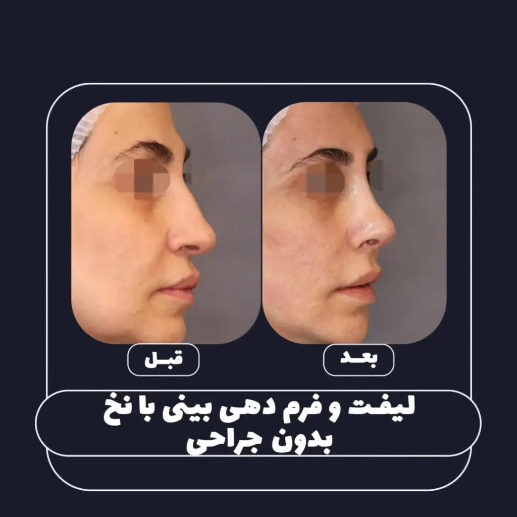 فرم دهی بینی بدون جراحی با نخ