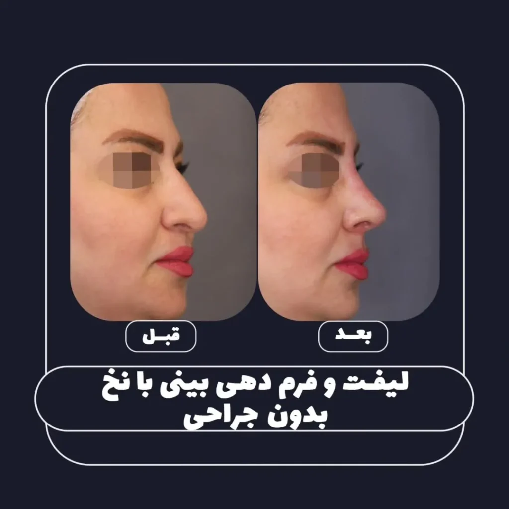 فرم دهی بینی بدون جراحی با نخ