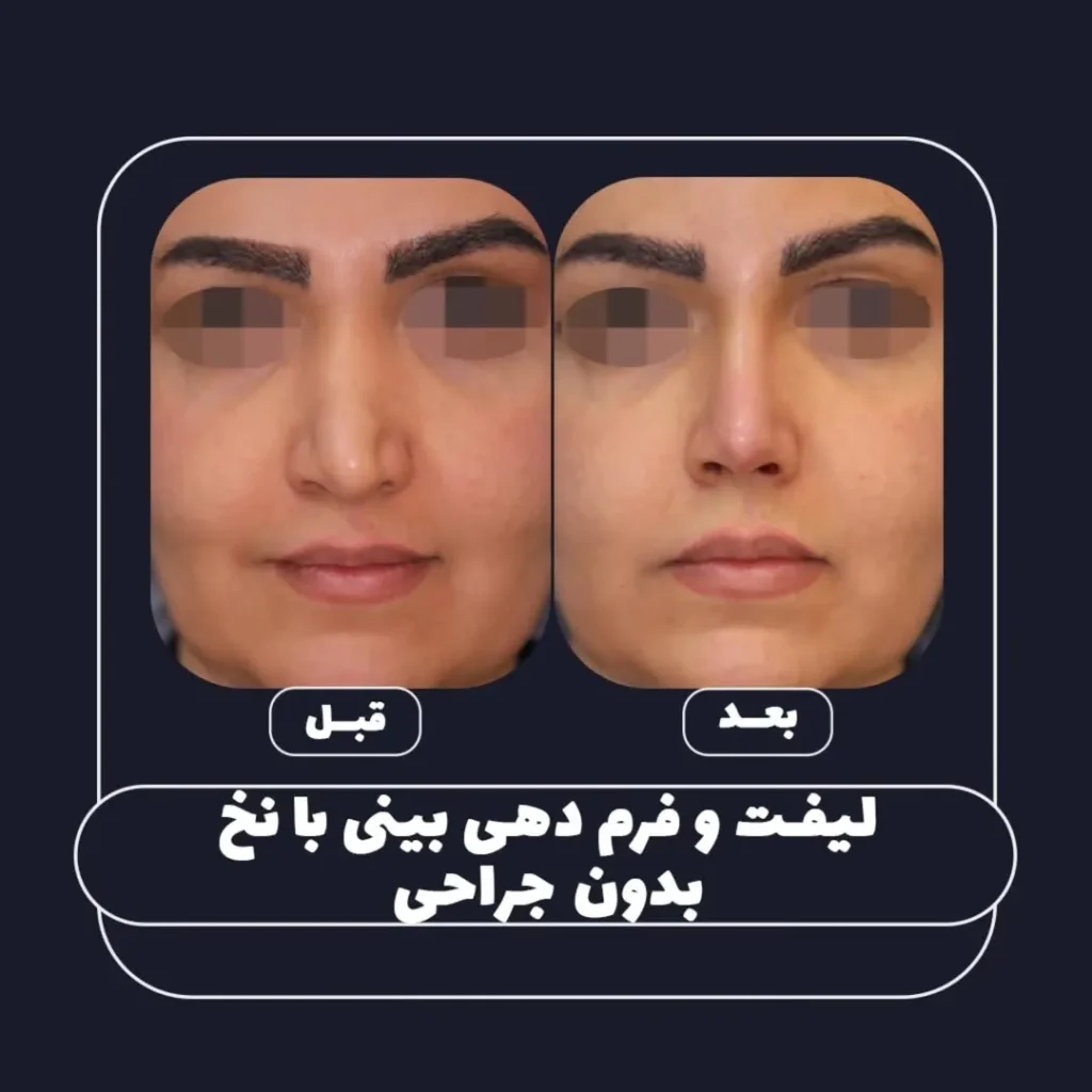 فرم دهی بینی بدون جراحی