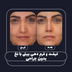 فرم دهی بینی بدون جراحی