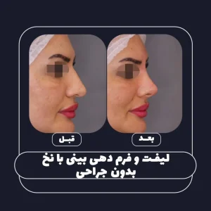 لیفت بینی با نخ