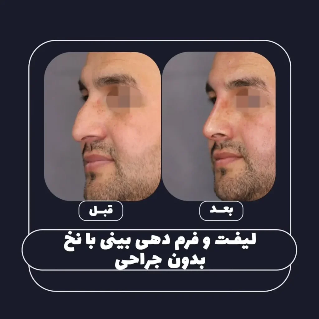 لیفت بینی با نخ آقایان