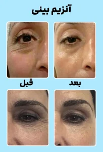 قبل و بعد پروفایلو