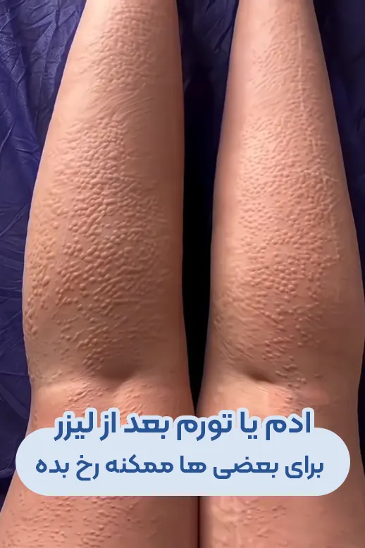 ادم و تورم بعد لیزر موی زائد
