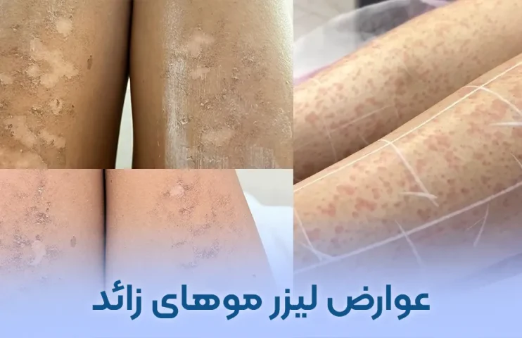 عوارض لیزر موهای زائد