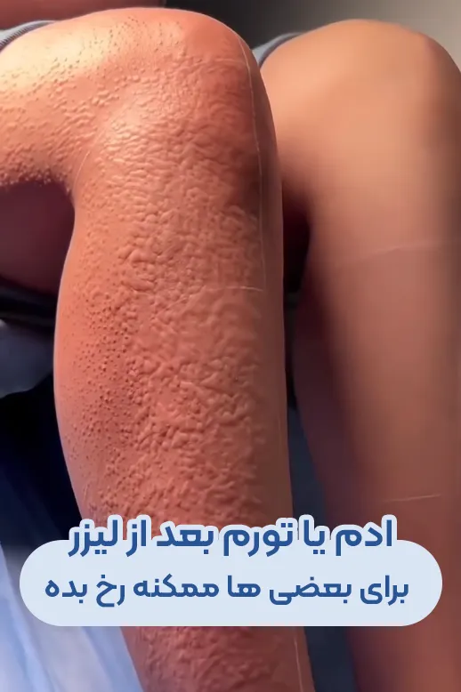 عوارض لیزر موهای زائد