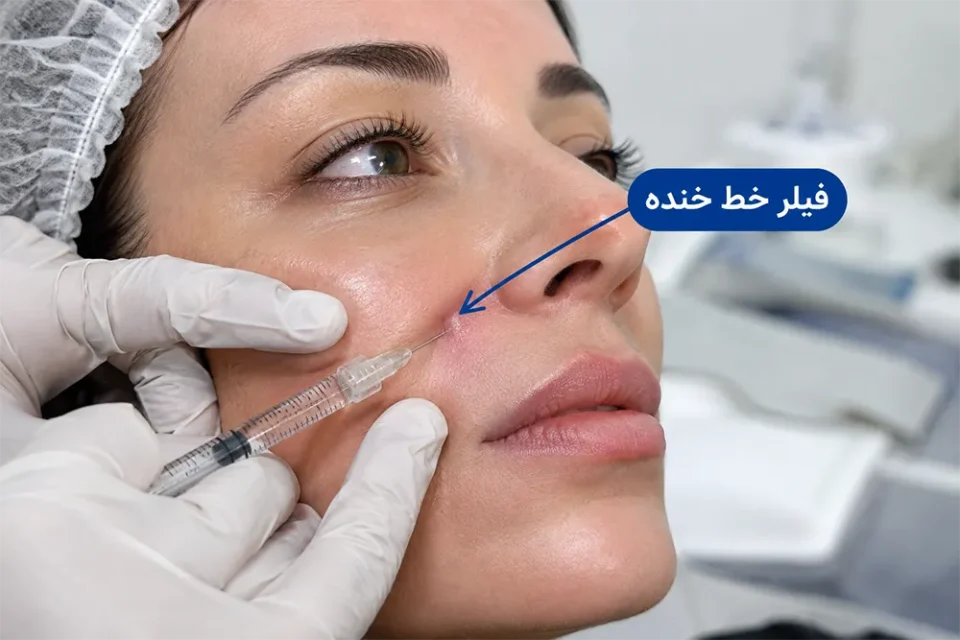 تزریق ژل خط خنده