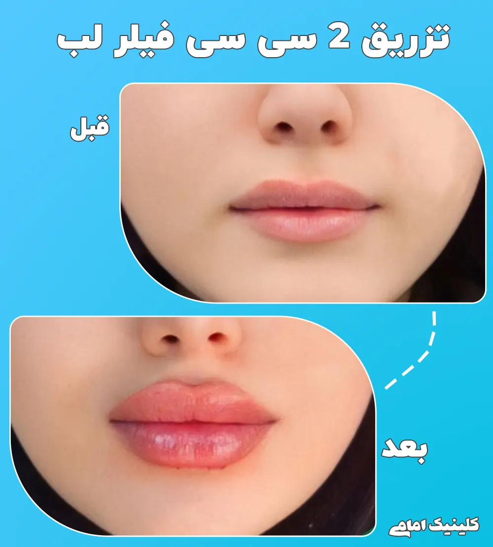 تزریق ژل لب