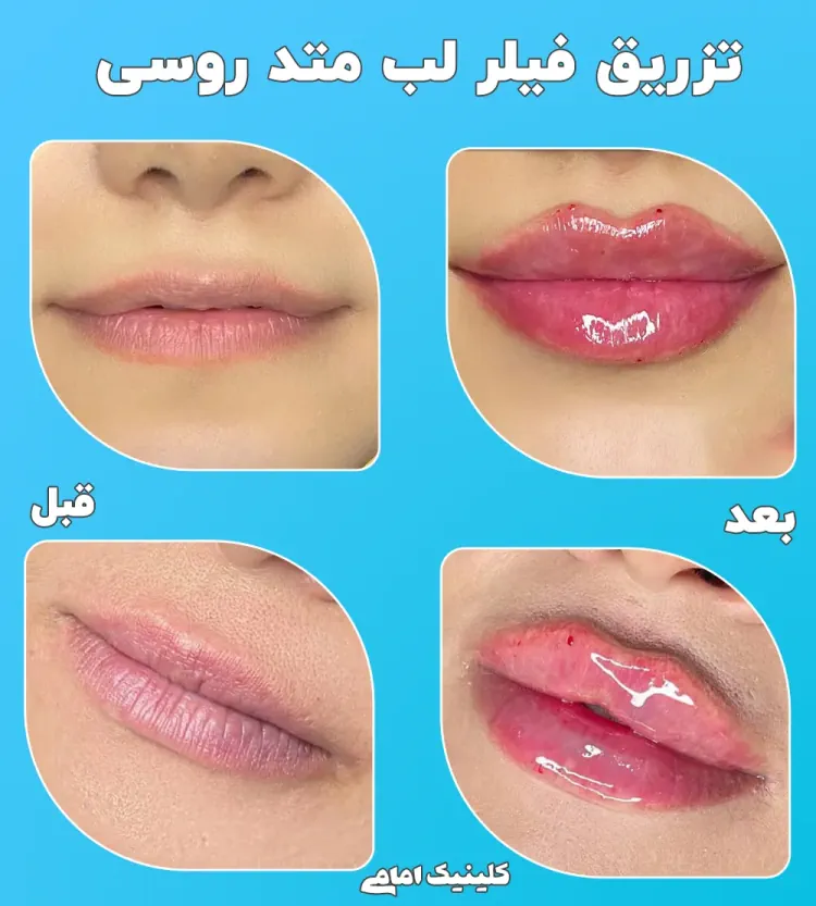 تزریق فیلر لب