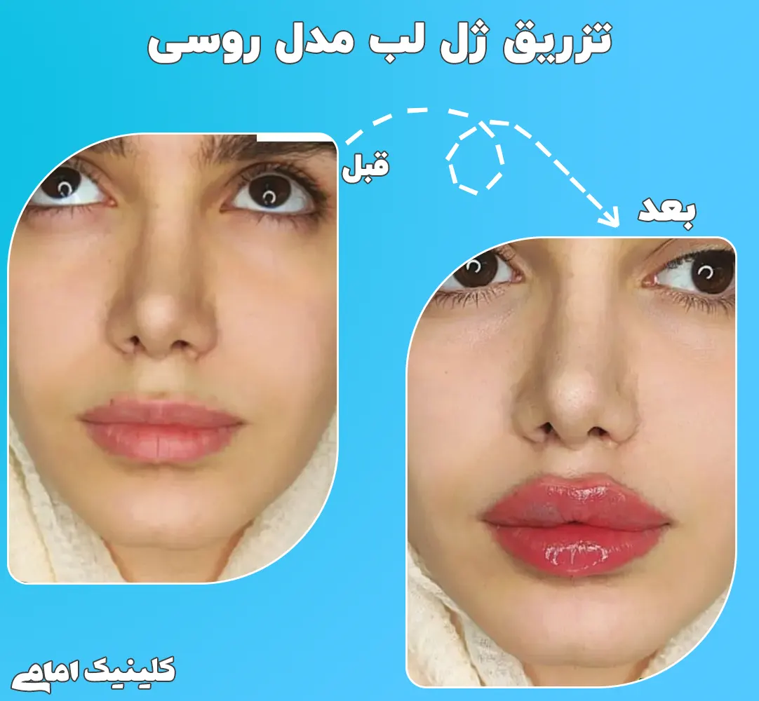 تزریق ژل لب روسی