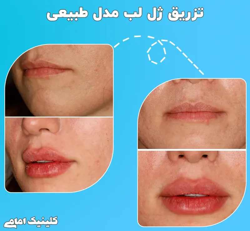 تزریق ژل لب طبیعی