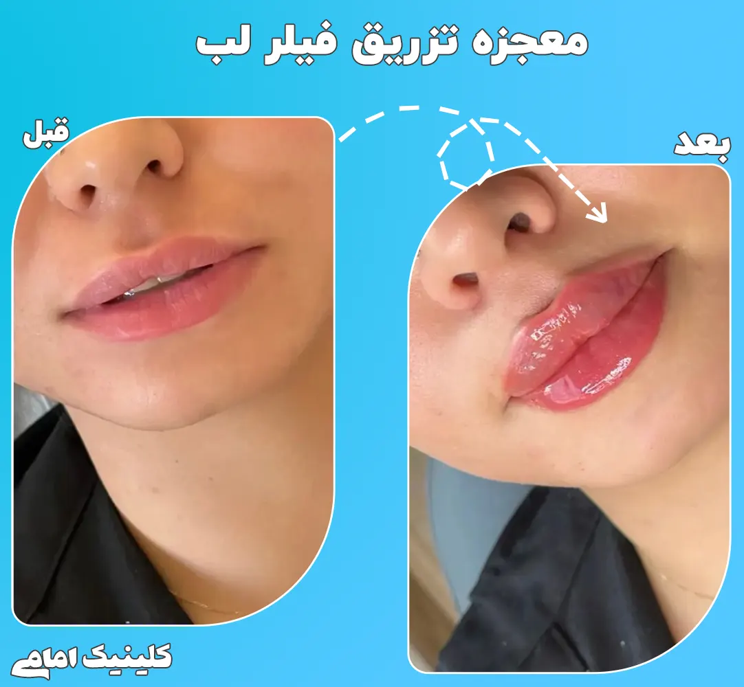 تزریق ژل لب