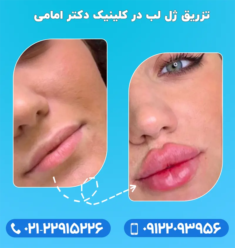 تزریق ژل لب