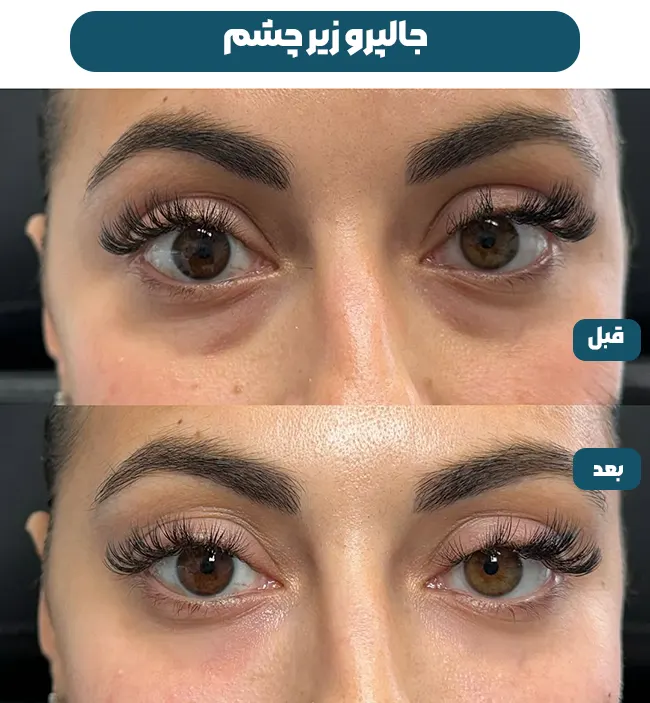 قبل و بعد جالپرو زیر چشم