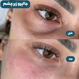 قبل و بعد جالپرو زیر چشم
