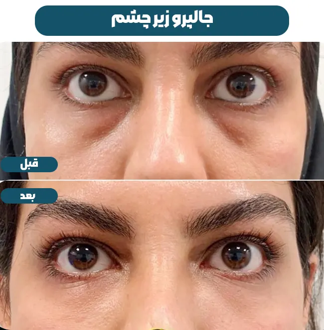 قبل و بعد جالپرو زیر چشم