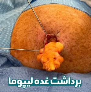 برداشت لیپوما