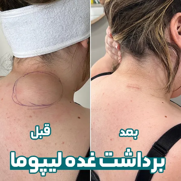 قبل و بعد برداشت لیپوما