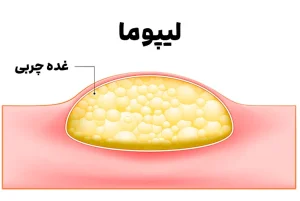 لیپوما