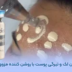درمان لک و تیرگی پوست با مزووایت