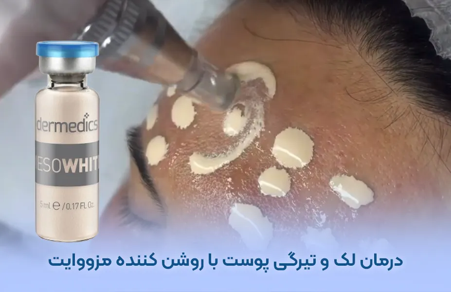درمان لک و تیرگی پوست با مزووایت