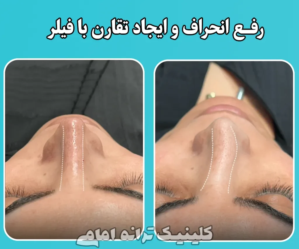 رفع انجراف با فیلر بینی