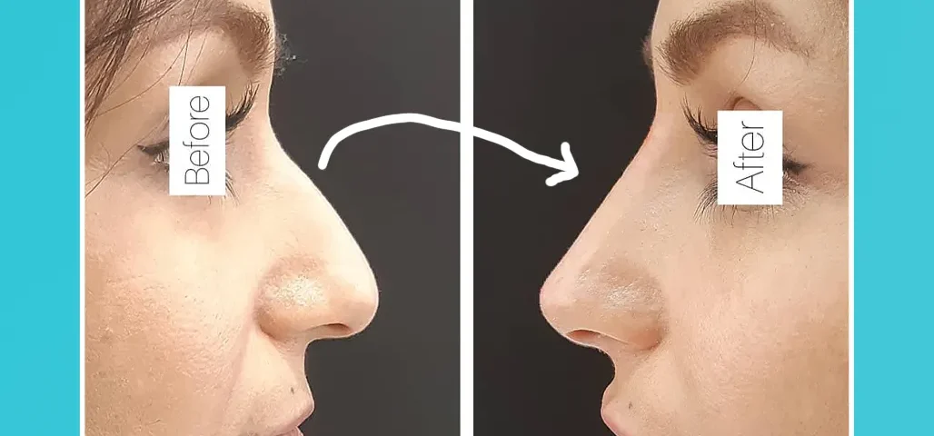 تزریق فیلر بینی