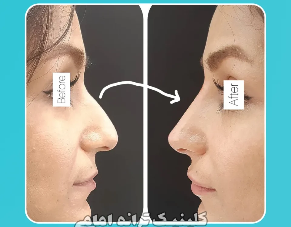 تزریق فیلر بینی