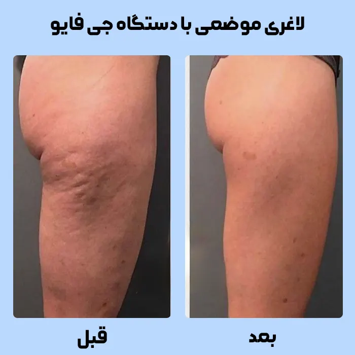 لاغری و رفع سلولیت با دستگاه جی فایو