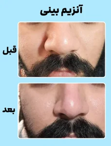 آنزیم بینی قبل و بعد