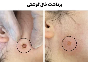 برداشت خال گوشتی