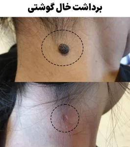 برداشت خال گوشتی