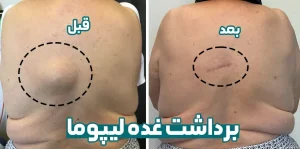 برداشت غذه لیپوما