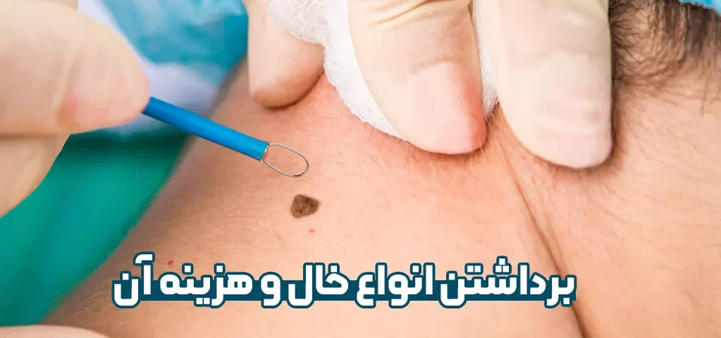 برداشتن خال و هزینه آن