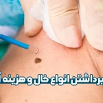 برداشتن خال و هزینه آن