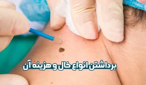 برداشتن خال و هزینه آن