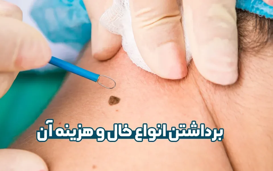 برداشتن خال و هزینه آن