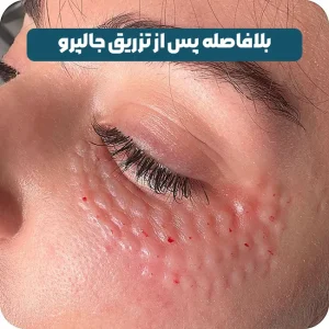 بلافاصه بعد از تزریق جالپرو