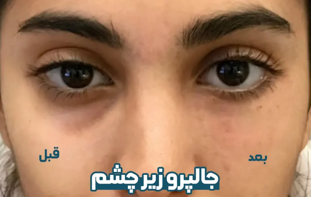 جالپرو زیر چشم