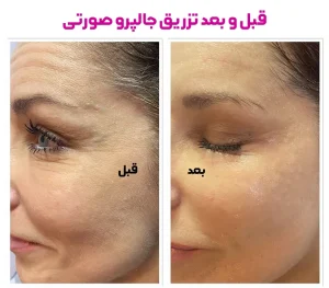 قبل و بعد جالپرو صورتی