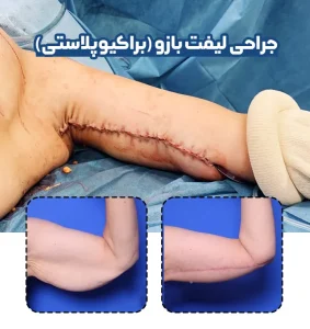 روش لیفت بازو (براکیوپلاستی)