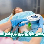 جوابدهی کرایولیپولیز چقدر است